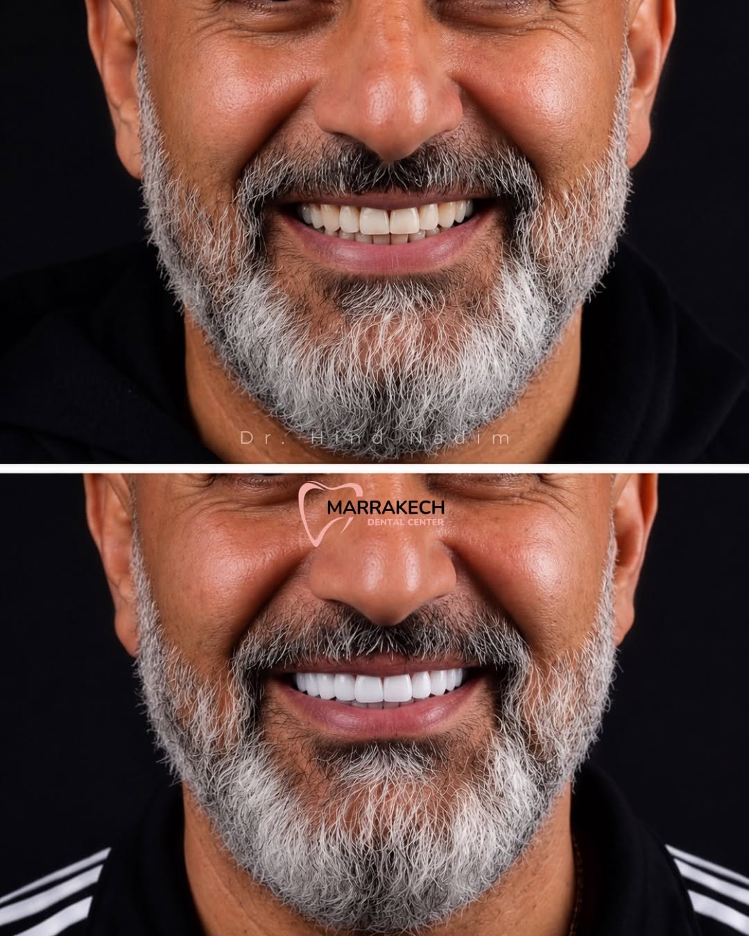 Before and after smile transformation with premium ceramic veneers and crowns by Dr Hind Nadim in Marrakech, creating a natural, brighter and harmonious smile with high-end aesthetic dentistry.