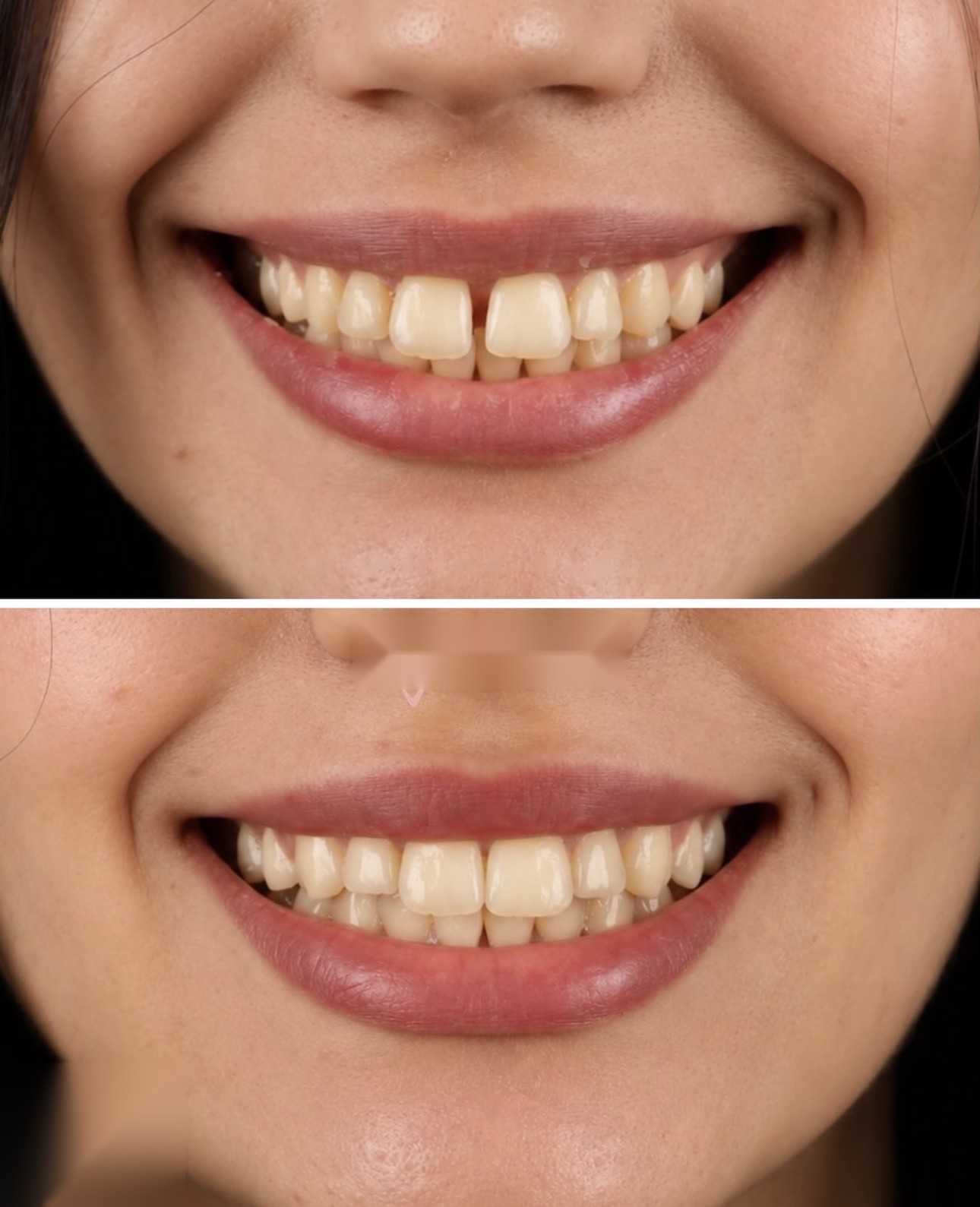 Alignement des dents de devant : avant et après