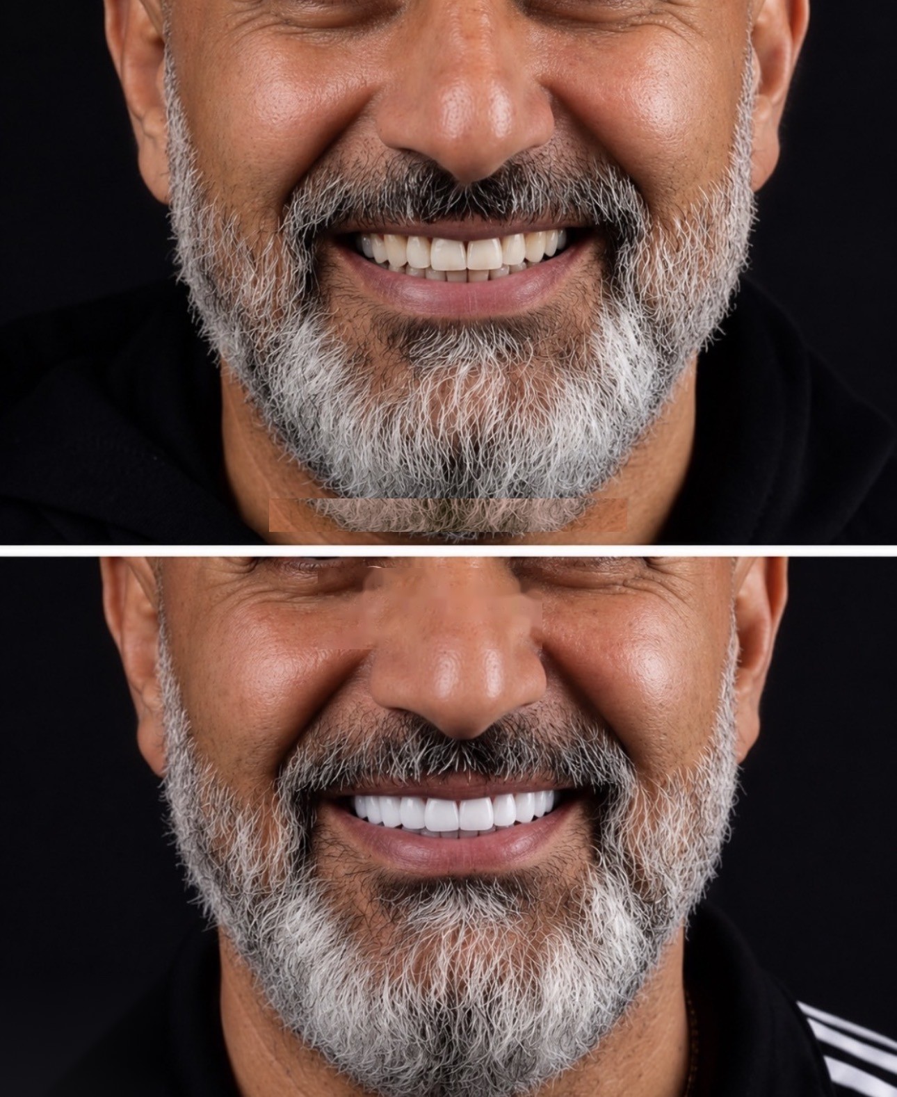 Réhabilitation complète du sourire : avant et après